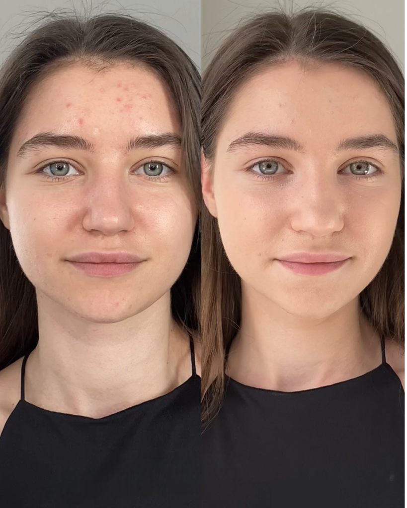 Косметика для проблемной кожи: какие компоненты подсушивают кожу и уменьшают воспаления Косметика для проблемной кожи: какие компоненты подсушивают кожу и уменьшают воспаления